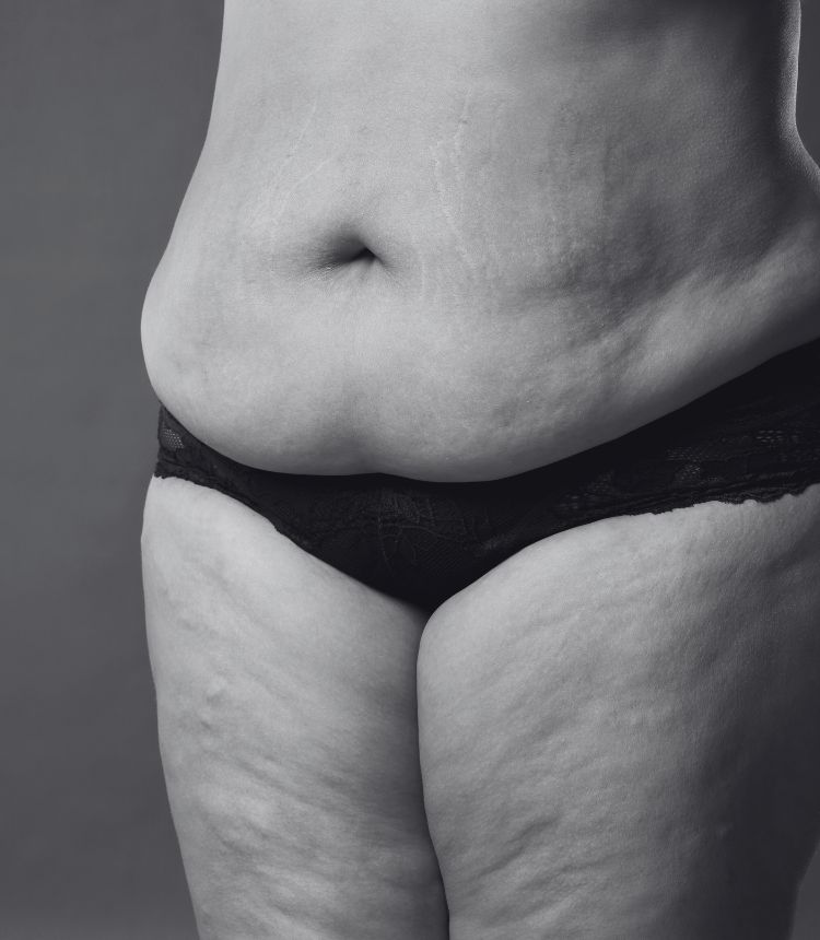 Image comparing mild and severe cellulite grades Little Bognor