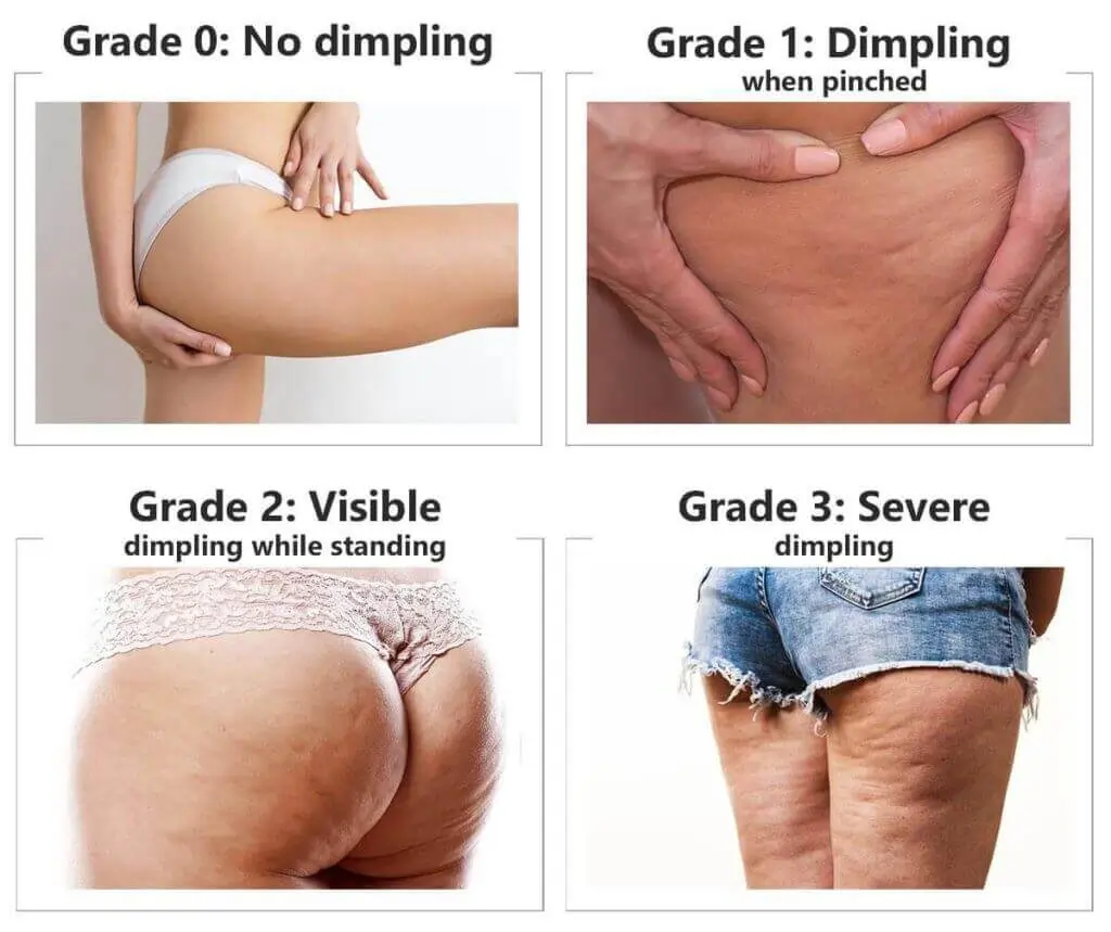 Representation of the stages of cellulite development Little Bognor