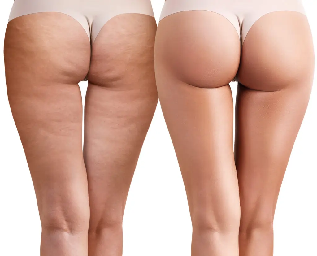 Read about cellulite Little Bognor: causes, treatments, and debunked myths